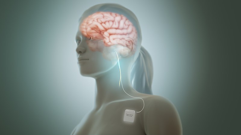 Vagus nerve stimulation